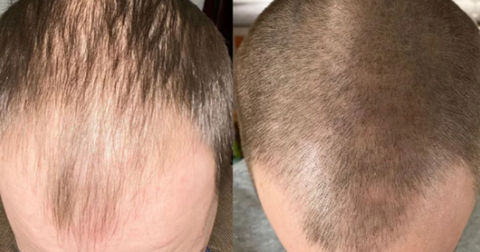 Minoxidil for Hair Fall Regrowth: Best Topical Solution for Thinning Hair| HEH 3 image 15