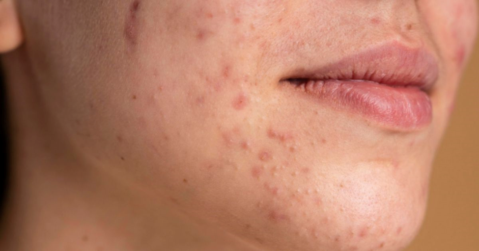 Skin Barrier Damage: Causes, Symptoms & How to Repair It Naturally| HEH 2 image 18